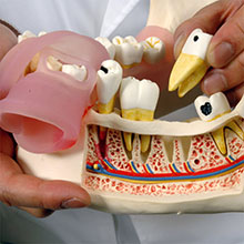 人体模型 歯と歯茎の疾患 詳細画像