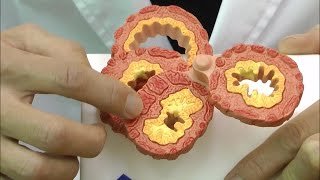 COPDの気管支モデル:動画