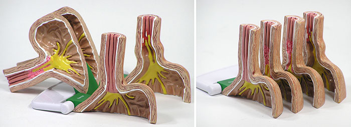 逆流性食道炎（GERD）4段階進行模型セットの全体像