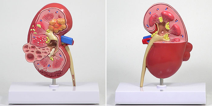 腎臓疾患モデルの全体像（疾患面）。結石や腫瘍などが確認できる。