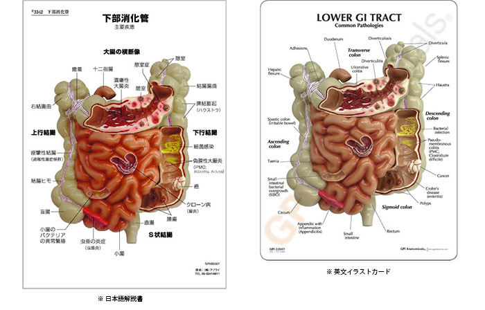 小腸・大腸疾患模型に付属する英文イラストカード