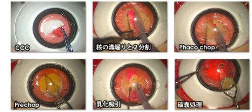 白内障手術練習用模擬眼　机太郎ウェットラボセット 詳細画像6