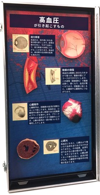 3D模型ディスプレイ 高血圧の危険性の左側のパネル。立体模型4個と日本語の解説
