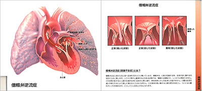 型抜き絵本 うっ血性心不全 13-14ページ