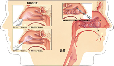 型抜き絵本 鼻腔と副鼻腔疾患 03-04ページ