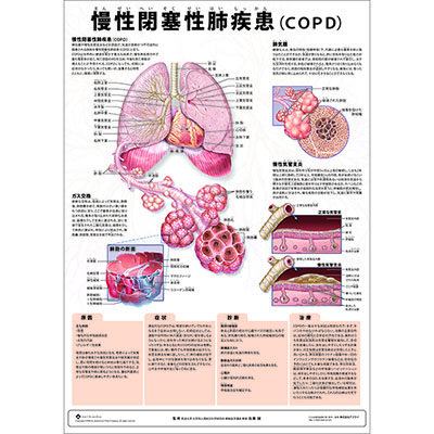 （医学ポスター）　ミニポスター　慢性閉塞性肺疾患（COPD)