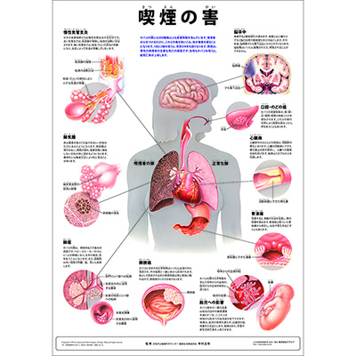 （医学ポスター）　ミニポスター　喫煙の害