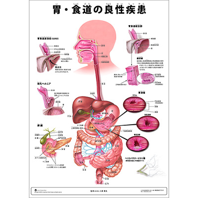 （医学ポスター）　ミニポスター　胃・食道の良性疾患