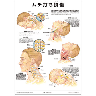 （医学ポスター）　ミニポスター　ムチ打ち損傷