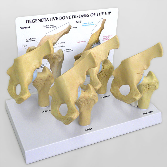 医学模型　変形性股関節症/4段階　GPI Anatomicals