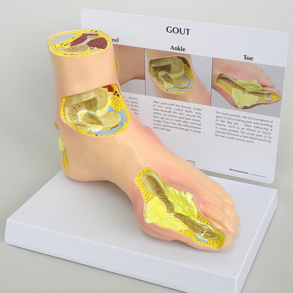 医学模型　痛風　GPI Anatomicals
