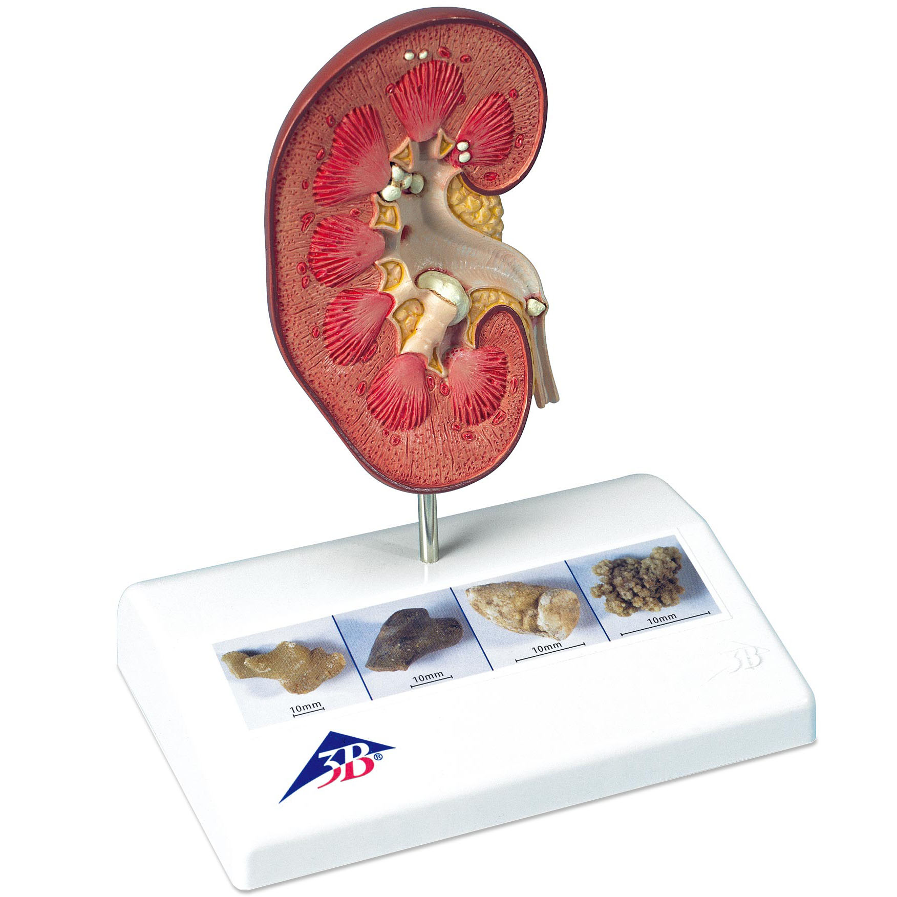 医学模型　腎結石