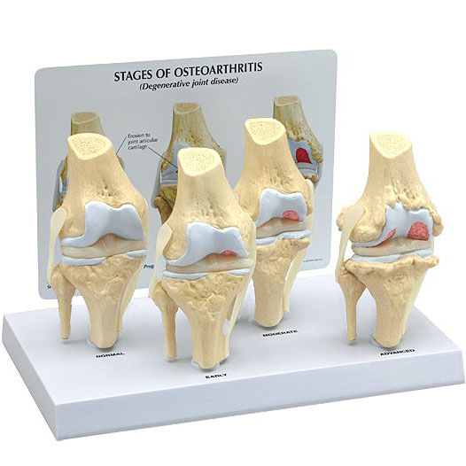 医学模型　変形性膝関節症/4段階　GPI Anatomicals