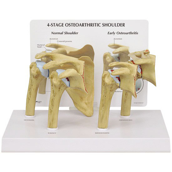 医学模型　変形性肩関節症/4段階　GPI Anatomicals