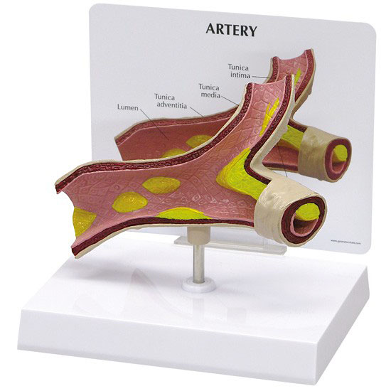 医学模型　動脈硬化　GPI Anatomicals