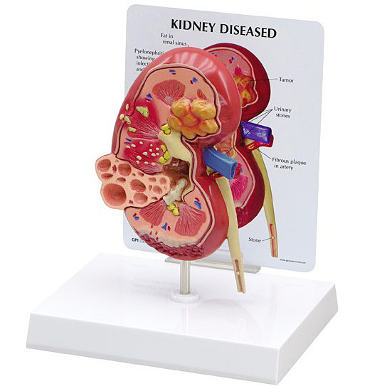 人体模型　腎臓と諸疾患　GPI Anatomicals