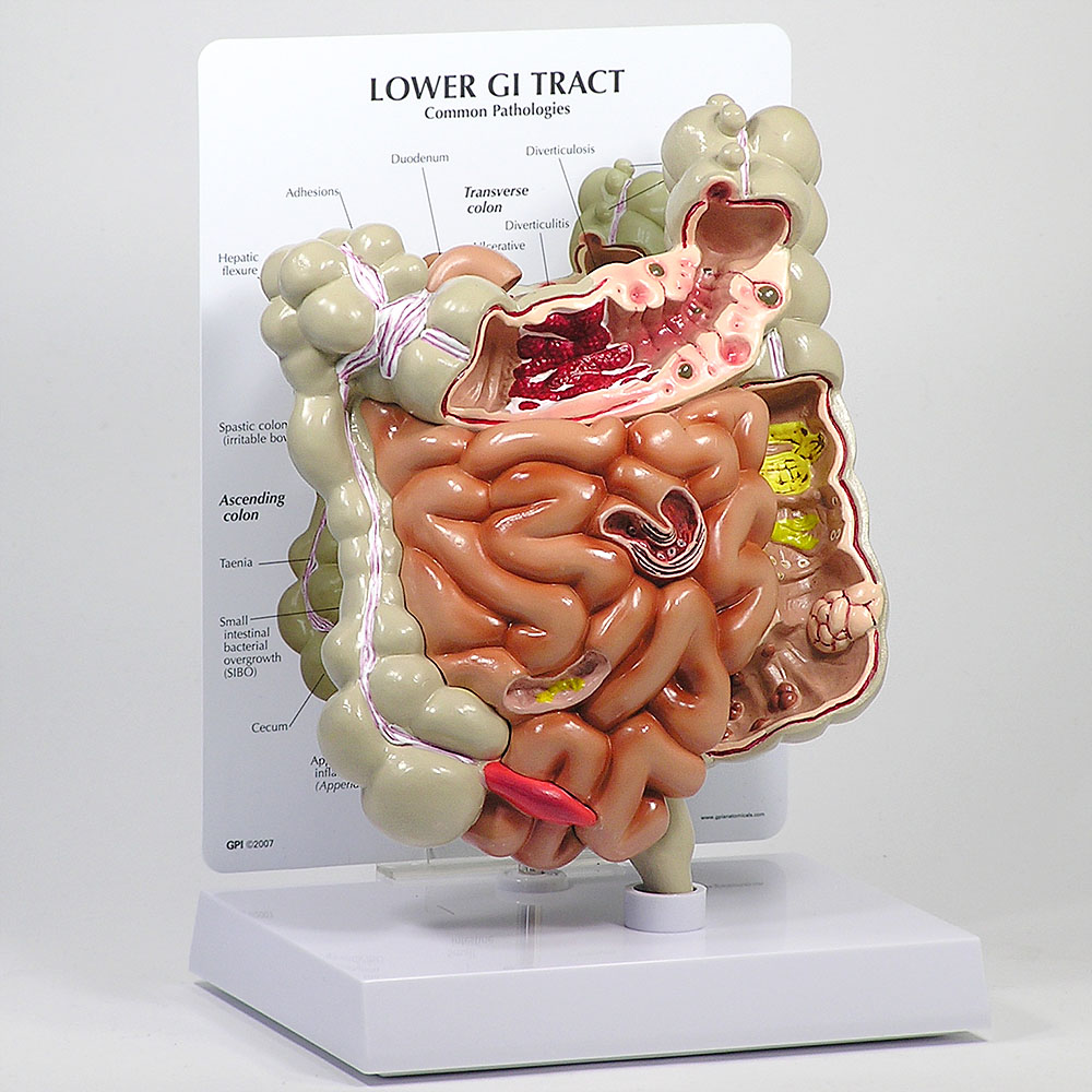 医学模型　大腸・小腸の諸疾患　GPI Anatomicals