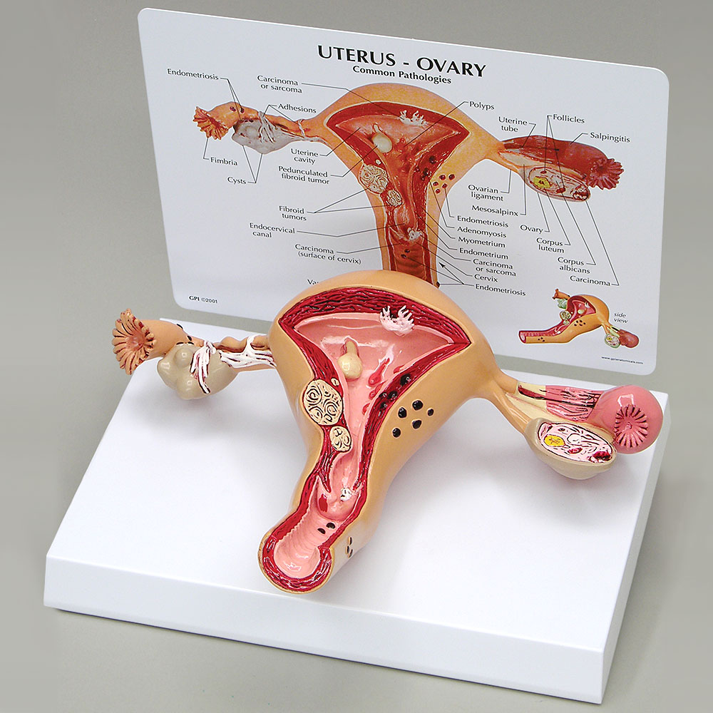 医学模型　子宮と卵巣の諸疾患　GPI Anatomicals