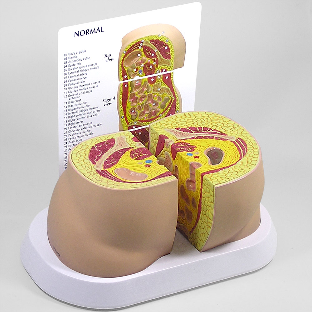 医学模型　肥満のタイプ　GPI Anatomicals