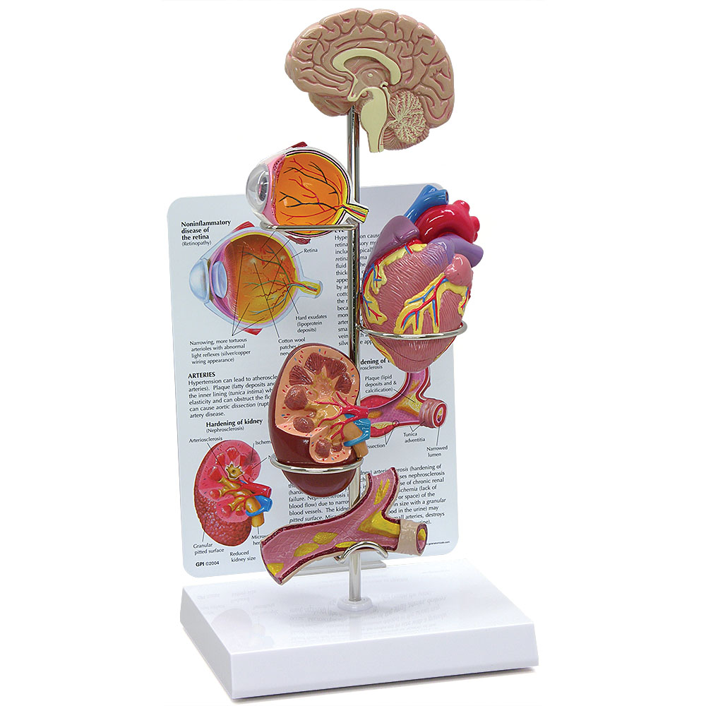 医学模型　高血圧の影響　GPI Anatomicals