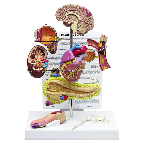 医学模型　2型糖尿病　GPI Anatomicals