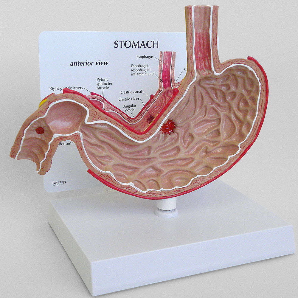 医学模型　胃と潰瘍　GPI Anatomicals