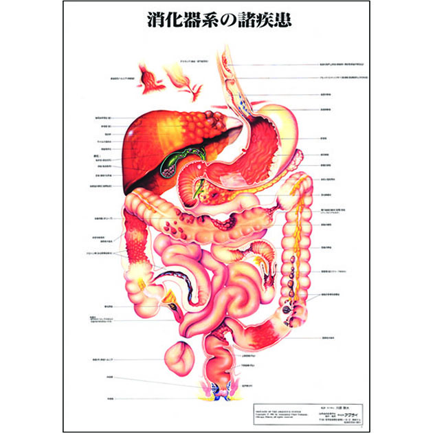 （医学ポスター）　医学掛図　消化器系の諸疾患